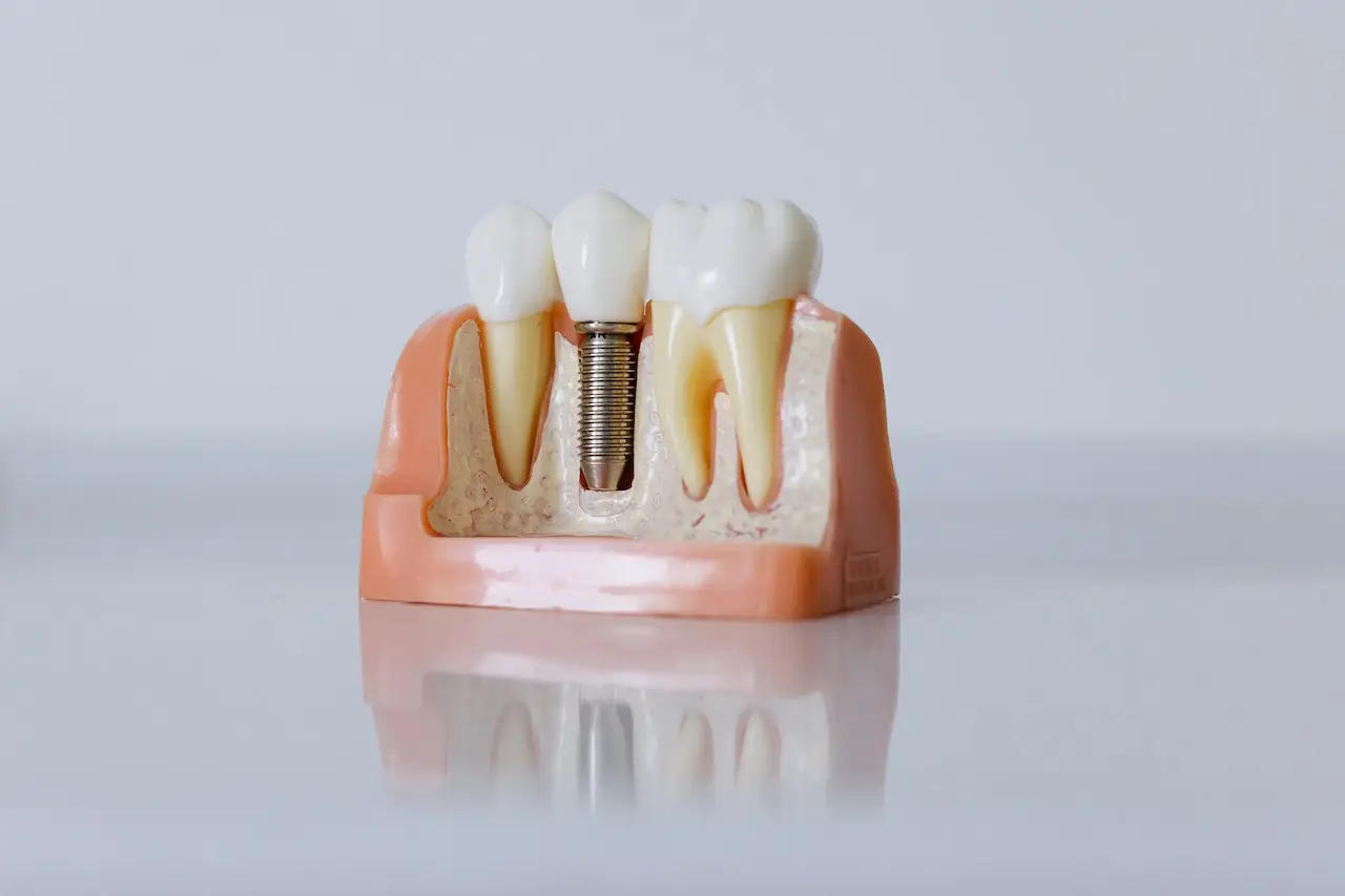 all-on-4-vs-all-on-6-dental-implants