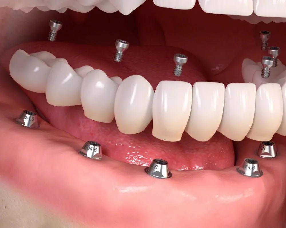 all-on-6 dental implants procedure