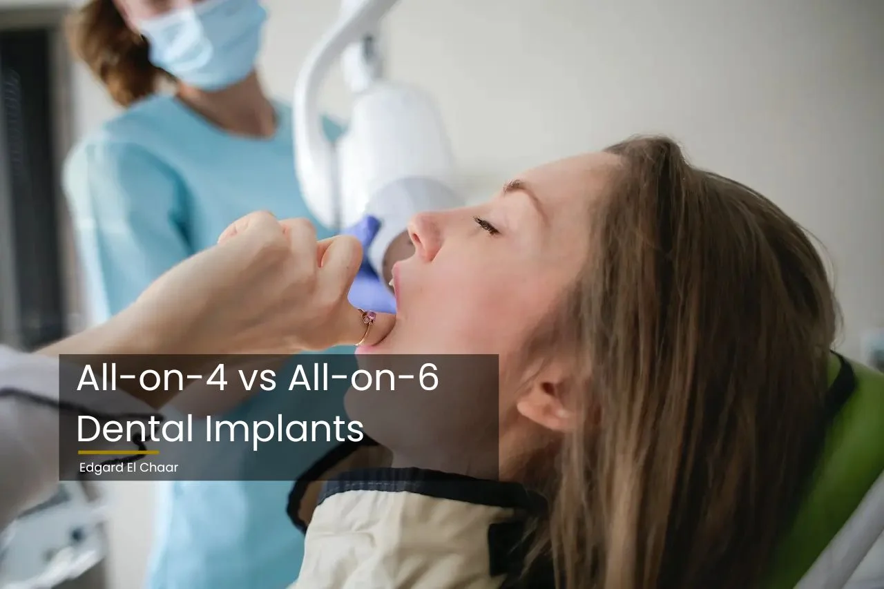 all on 4 vs all on 6 dental implants