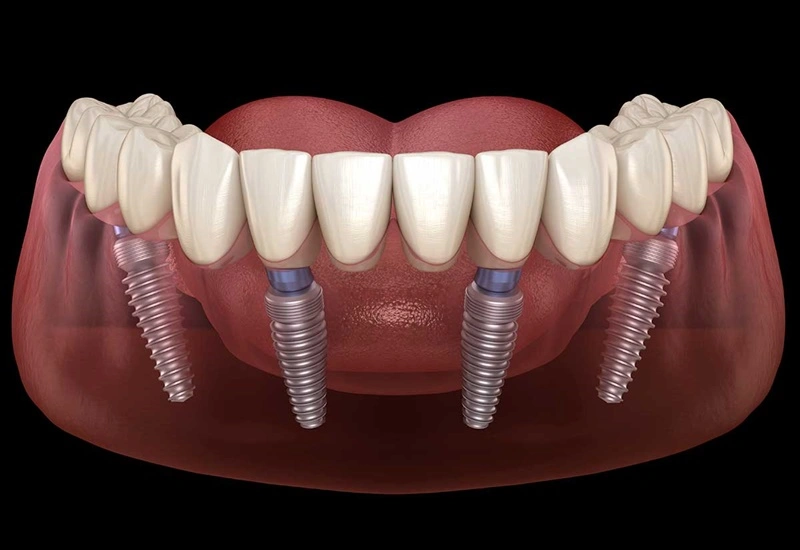 all-on-4 dental implants