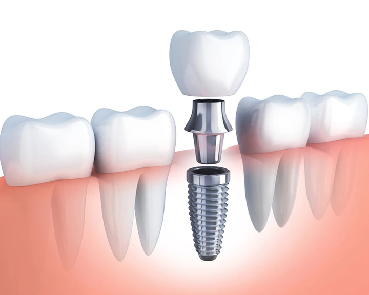 what-is-a-dental-implant