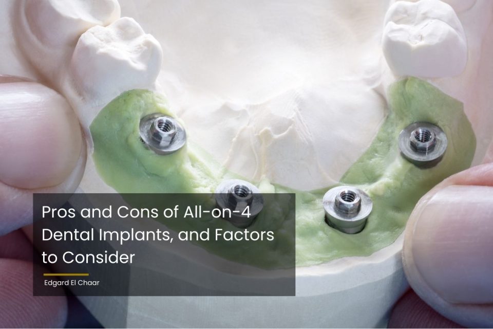 Pros and cons of all on 4 dental implants and factors to consider