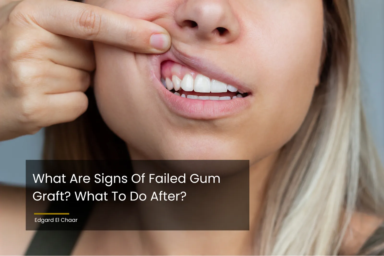 Signs Of Failed Gum Graft